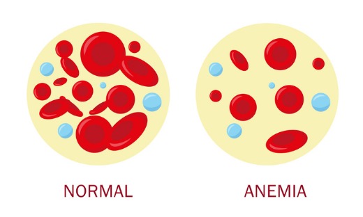 anemia saat hamil