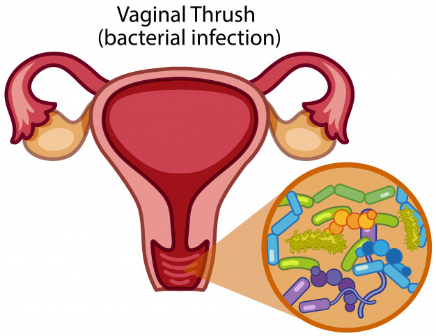 vagina gatal saat hamil