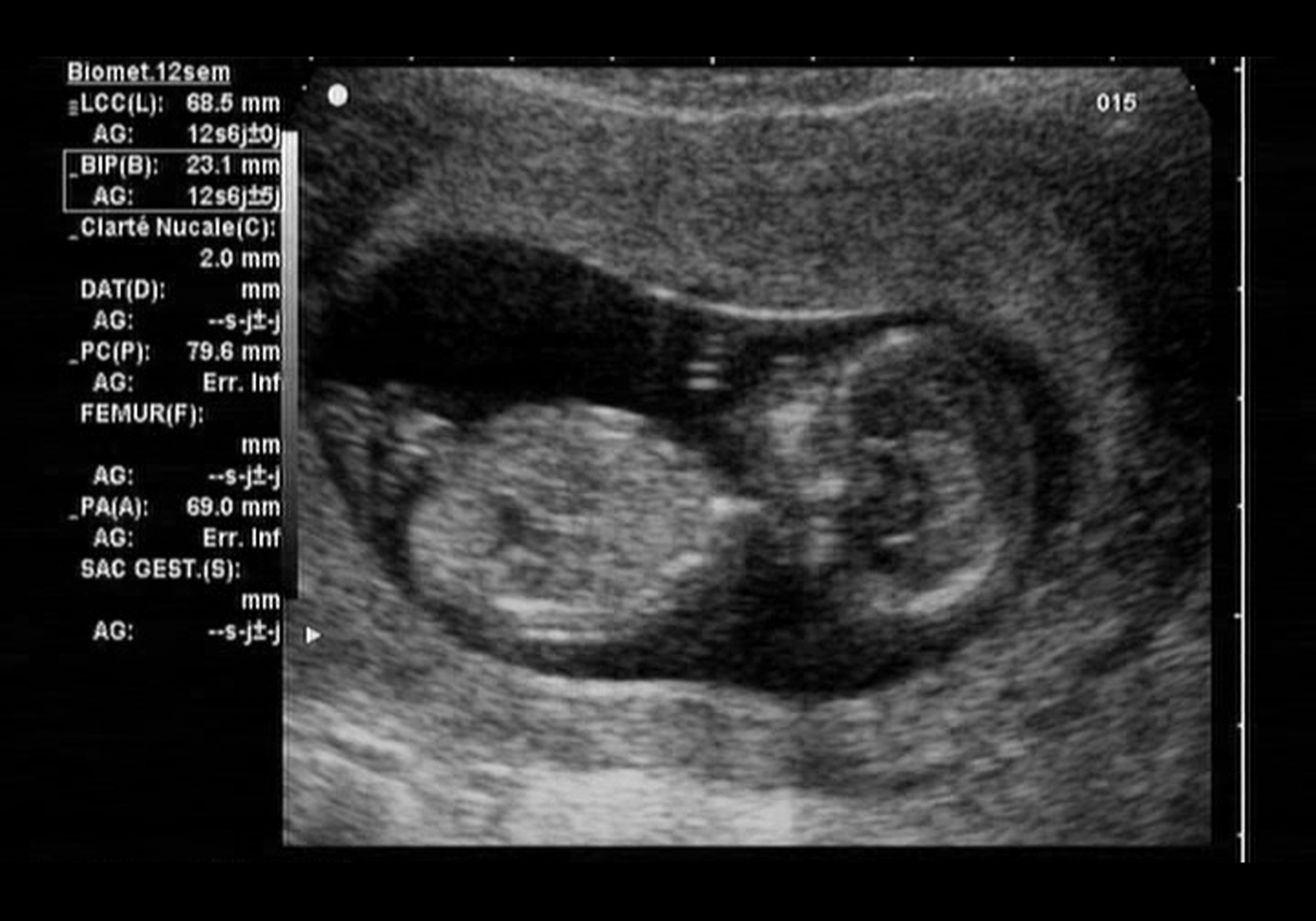 Скрининговое УЗИ на 12 неделе беременности