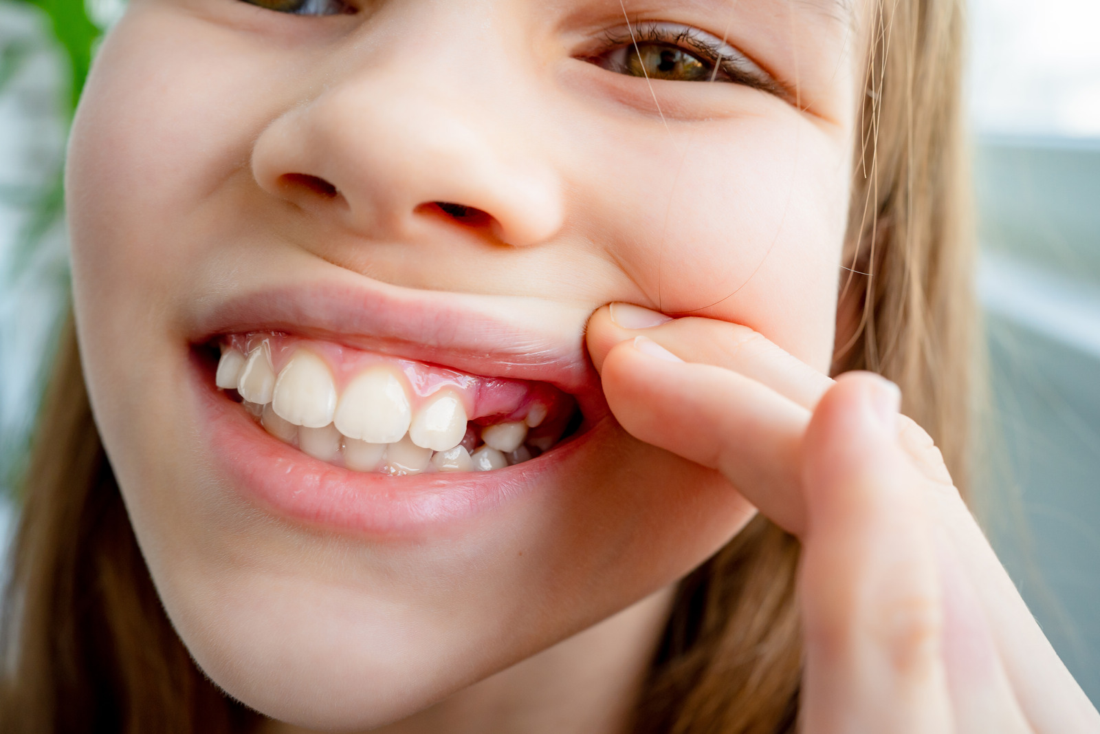 sakit gigi gusi bengkak pada anak apa obatnya 10