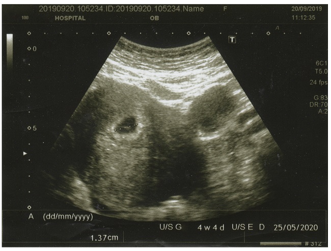 Hamil 5 Minggu, Tanda Kehamilan Sudah Mulai Muncul