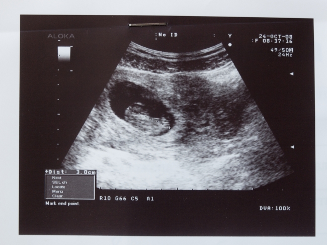ukuran janin 3 bulan, diary bunda